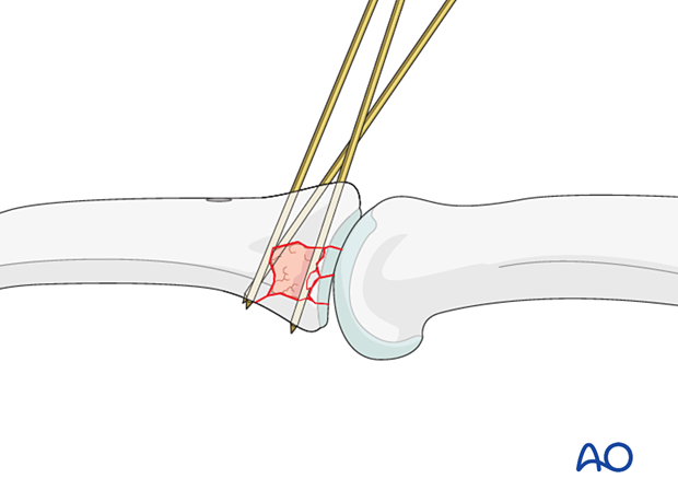 Joint reconstruction of palmar impaction fracture, consider buttressing bone graft with one or more K-wires.