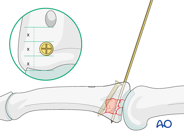 Joint reconstruction of palmar impaction fracture, use position screw or antiglide plate for buttressing bone graft.