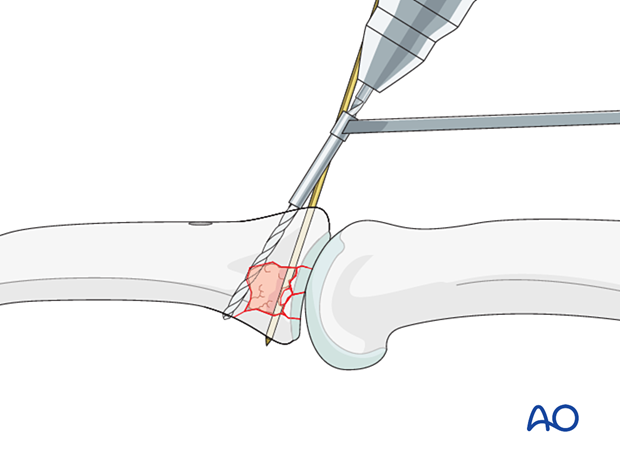 Joint reconstruction of palmar impaction fracture, drill hole through both cortices, measure screw length accurately.