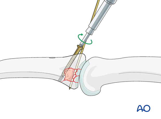 Joint reconstruction of palmar impaction fracture, gently insert screw, second screw may be inserted similarly.
