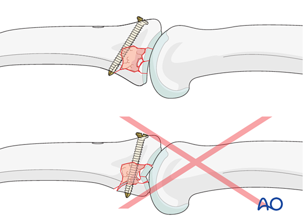 Joint reconstruction of palmar impaction fracture, insert screw to exit through uninjured cortical bone, avoid collapse.