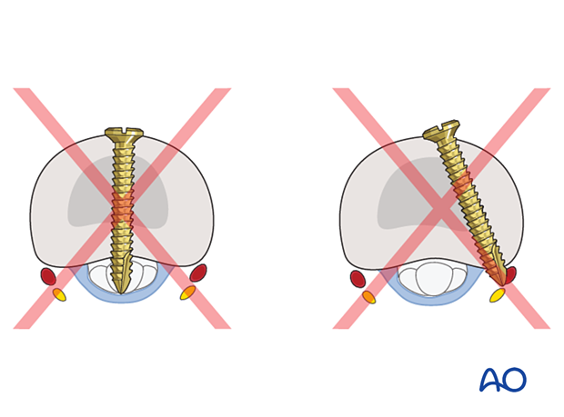 Joint reconstruction of palmar impaction fracture, avoid long screws to prevent neurovascular injury or tendon irritation.