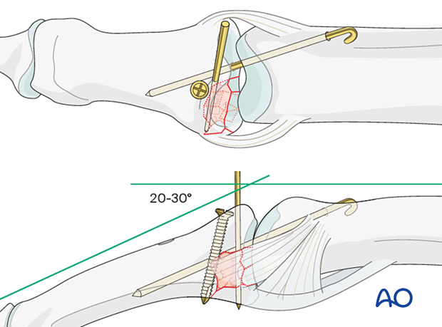 Joint reconstruction of palmar impaction fracture, PIP joint transfixed with K-wire in flexion, removed after 3-4 weeks.