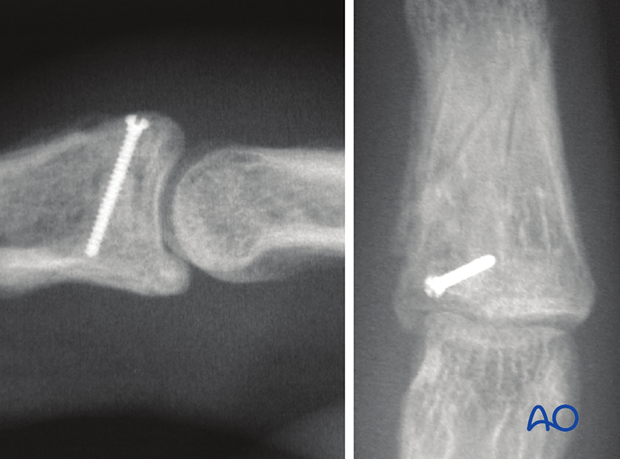 Joint reconstruction of palmar impaction fracture, check joint congruity with x-ray, ensure anatomical reduction.
