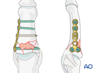 Plate fixation of a multifragmentary articular fracture of the middle phalangeal base