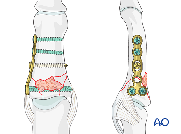 Plate fixation of middle phalangeal base fracture, reduce and fix articular fragments first, then extraarticular.