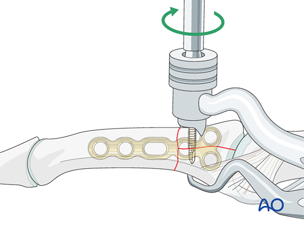 Plate fixation of middle phalangeal base fracture, insert lag screw for T- or Y-shaped fracture, avoid plate interference.