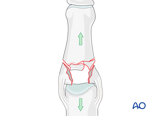 Plate fixation of middle phalangeal base fracture, direct reduction needed, restore joint surface, support with bone graft.