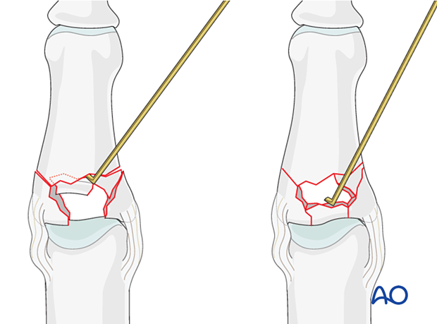 Plate fixation of middle phalangeal base fracture, use K-wire or dental pick to push fragments, ensure articular congruity.