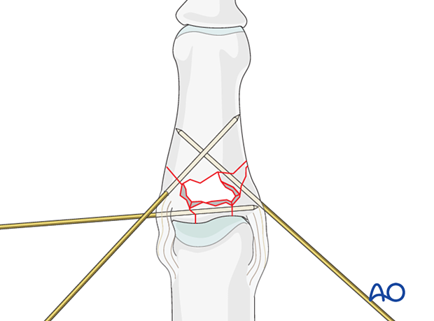 Plate fixation of middle phalangeal base fracture, use small K-wires for preliminary fixation and support of subchondral fragments.