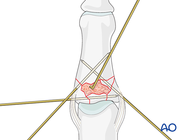 Plate fixation of middle phalangeal base fracture, use pusher to fill fracture cavity with bone graft, confirm reduction.