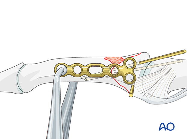 Plate fixation of middle phalangeal base fracture, place plate dorsal to midaxial line, secure with atraumatic forceps.