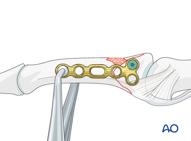 Plate fixation of middle phalangeal base fracture, insert locking head screw, avoid protrusion, check alignment with intensifier.