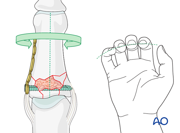 Plate fixation of middle phalangeal base fracture, manipulate distal phalanx to correct length and malrotation.