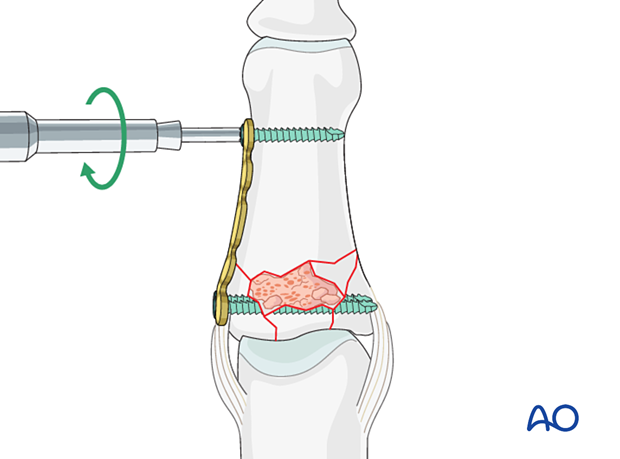 Plate fixation of middle phalangeal base fracture, add screw in diaphysis, recheck plate position and alignment with intensifier.