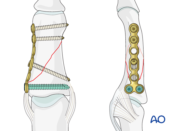 Compression plating of middle phalangeal shaft fracture, lateral application preferred, compression with plate or lag screw.