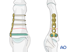 Compression plating of a transverse fracture of the middle phalanx
