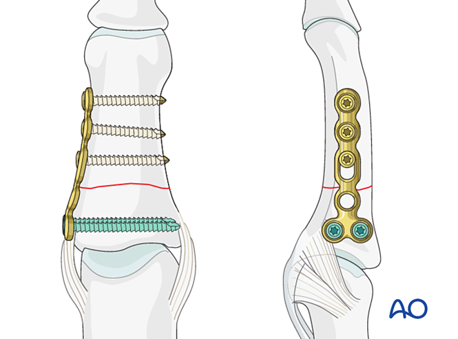 Compression plating for Transverse extraarticular or diaphyseal fracture