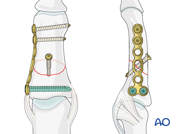 Compression plating of middle phalangeal shaft fracture, consider lag-screw fixation with neutralization plate if needed.
