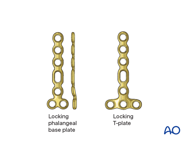 Compression plating of middle phalangeal shaft fracture, use low-profile plates, select based on fragment size and geometry.