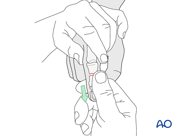 Compression plating of middle phalangeal shaft fracture, reduction by traction and flexion, confirm with image intensifier.