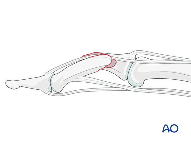 Compression plating of middle phalangeal shaft fracture, indirect reduction may be blocked by lateral band interposition.