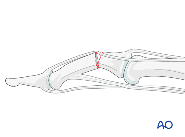 Compression plating of middle phalangeal shaft fracture, indirect reduction may be blocked by lateral band interposition.