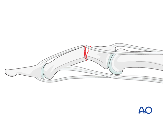 Compression plating for Transverse extraarticular or diaphyseal fracture