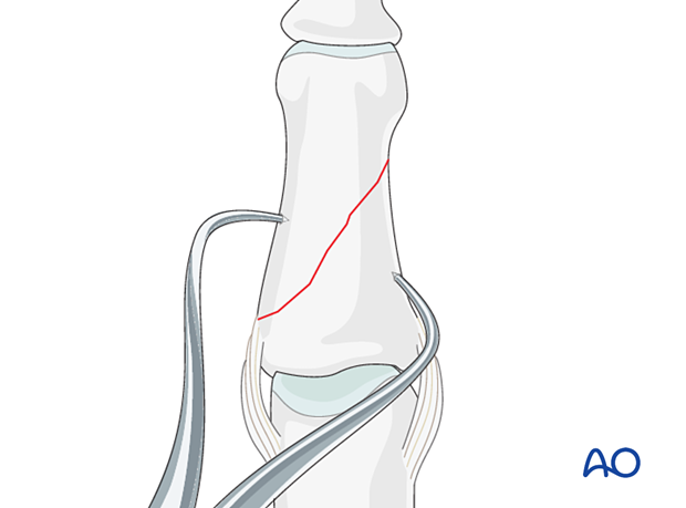 Compression plating of middle phalangeal shaft fracture, use pointed reduction forceps for direct reduction if unstable.