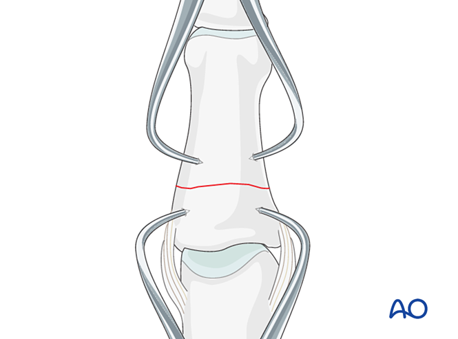 Compression plating for Transverse extraarticular or diaphyseal fracture