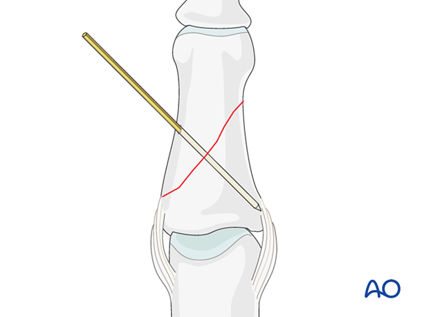 Compression plating of middle phalangeal shaft fracture, insert K-wire for provisional fixation.