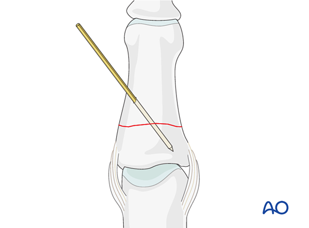 Compression plating of middle phalangeal shaft fracture, insert K-wire for provisional fixation.