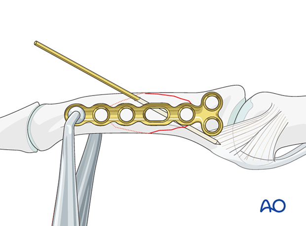 Compression plating of a middle phalangeal shaft fracture, plate slightly dorsal to midaxial line, two screws proximal.