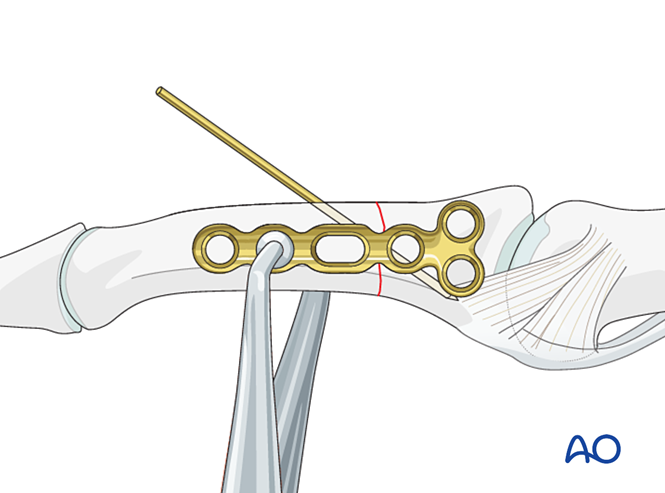 Compression plating for Transverse extraarticular or diaphyseal fracture