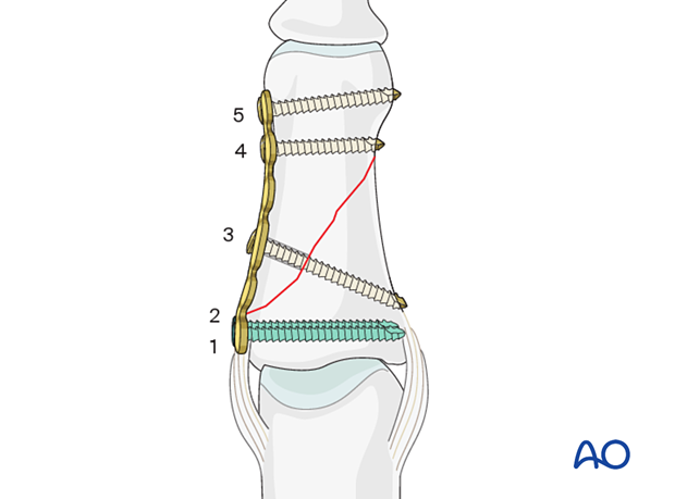 Compression plating of middle phalangeal shaft fracture, screws inserted by oblique fracture plane direction.