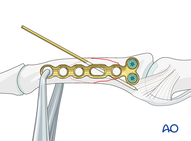 Compression plating of middle phalangeal shaft fracture, insert two locking head screws, confirm plate alignment.