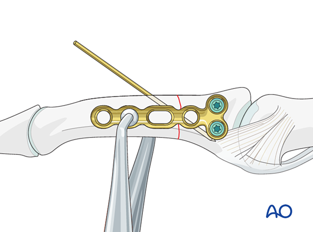 Compression plating of middle phalangeal shaft fracture, insert two locking head screws, confirm plate alignment.