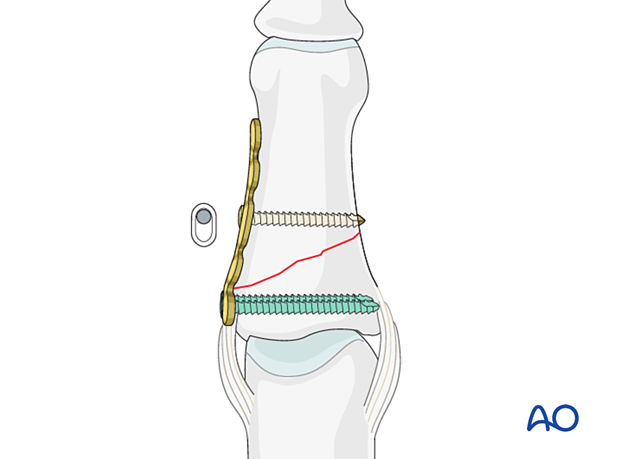 Compression plating of middle phalangeal shaft fracture, insert screw in compression mode, check plate position.