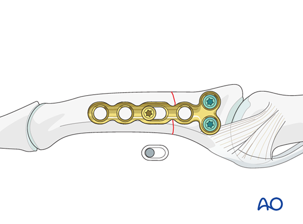 Compression plating of middle phalangeal shaft fracture, insert screw in compression mode, check plate position.