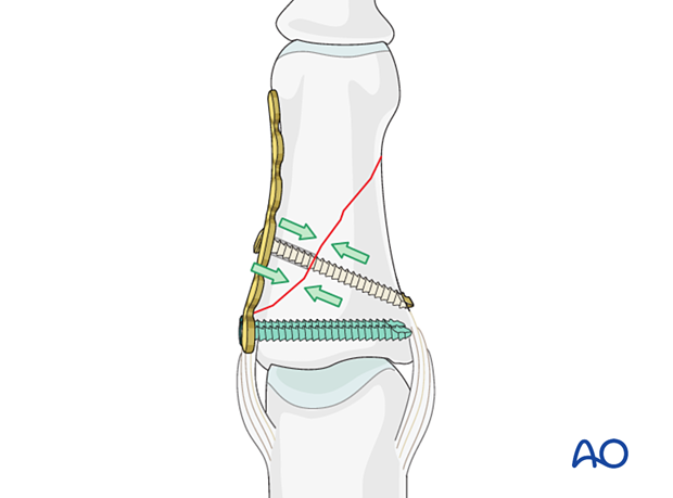 Compression plating of middle phalangeal shaft fracture, insert lag screw through oblong hole, perpendicular to fracture.