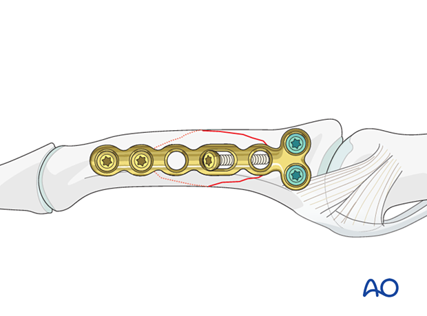 Compression plating of middle phalangeal shaft fracture, insert screws in shaft and proximal end, cover plate with periosteum.