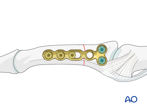 Compression plating of middle phalangeal shaft fracture, insert screws in shaft and proximal end, cover plate with periosteum.