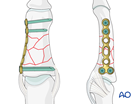Bridge plating of a multifragmentary fracture of the middle phalanx