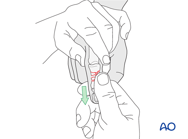 Bridge plating of multifragmentary middle phalangeal shaft fracture; length gained by manual traction.
