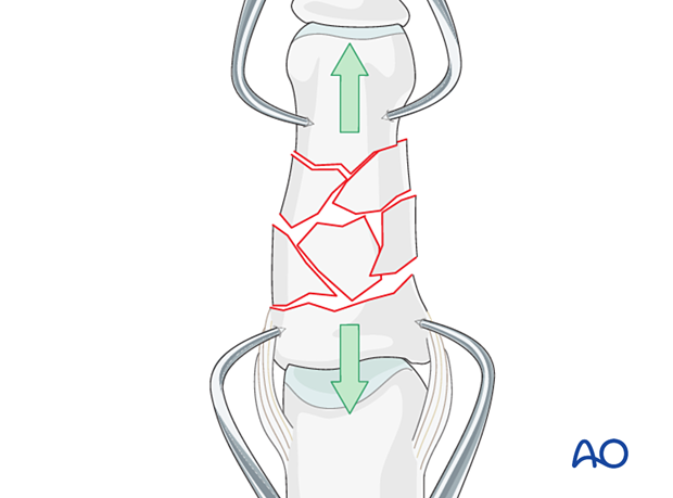 Bridge plating of multifragmentary middle phalangeal shaft fracture; length and rotation confirmed with forceps.