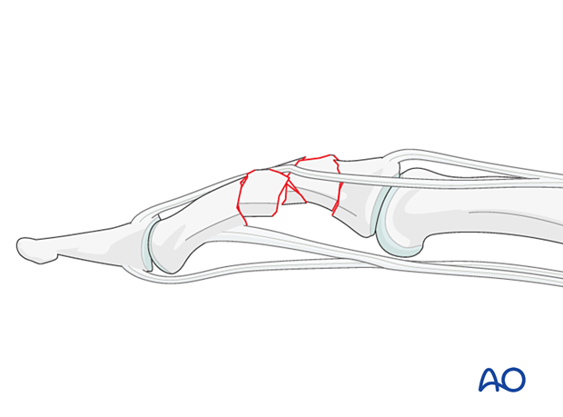 Bridge plating of multifragmentary middle phalangeal shaft fracture; indirect reduction may be blocked by lateral band.