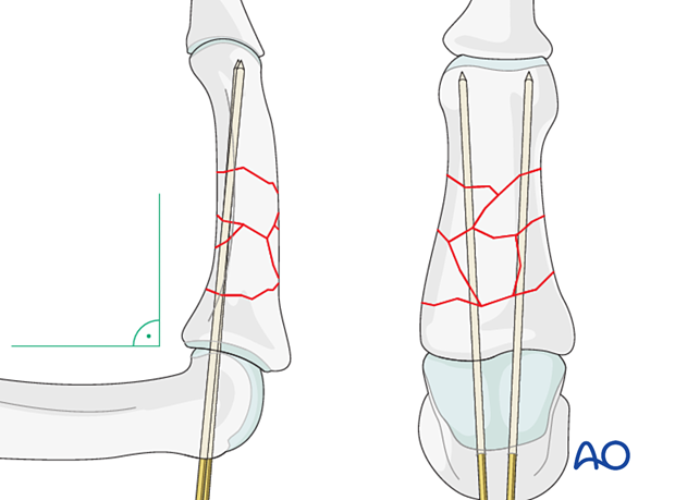 Bridge plating of multifragmentary middle phalangeal shaft fracture; K-wires provide provisional stabilization.