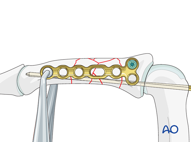 Bridge plating of multifragmentary middle phalangeal shaft fracture; insert locking head screw, check alignment with intensifier.