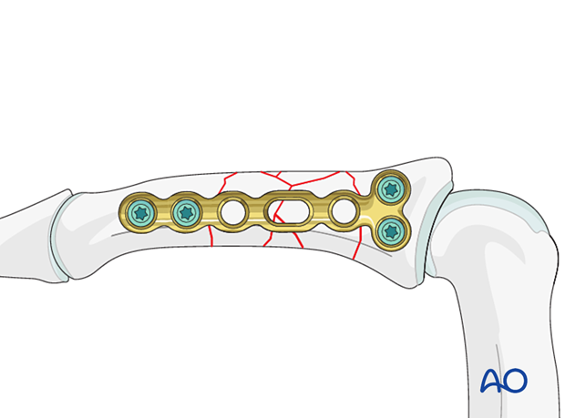 Bridge plating of multifragmentary middle phalangeal shaft fracture; add screw distal to fracture, cover plate with periosteum.