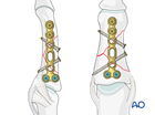 Lag-screw and plate fixation of a multifragmentary fracture of the middle phalanx